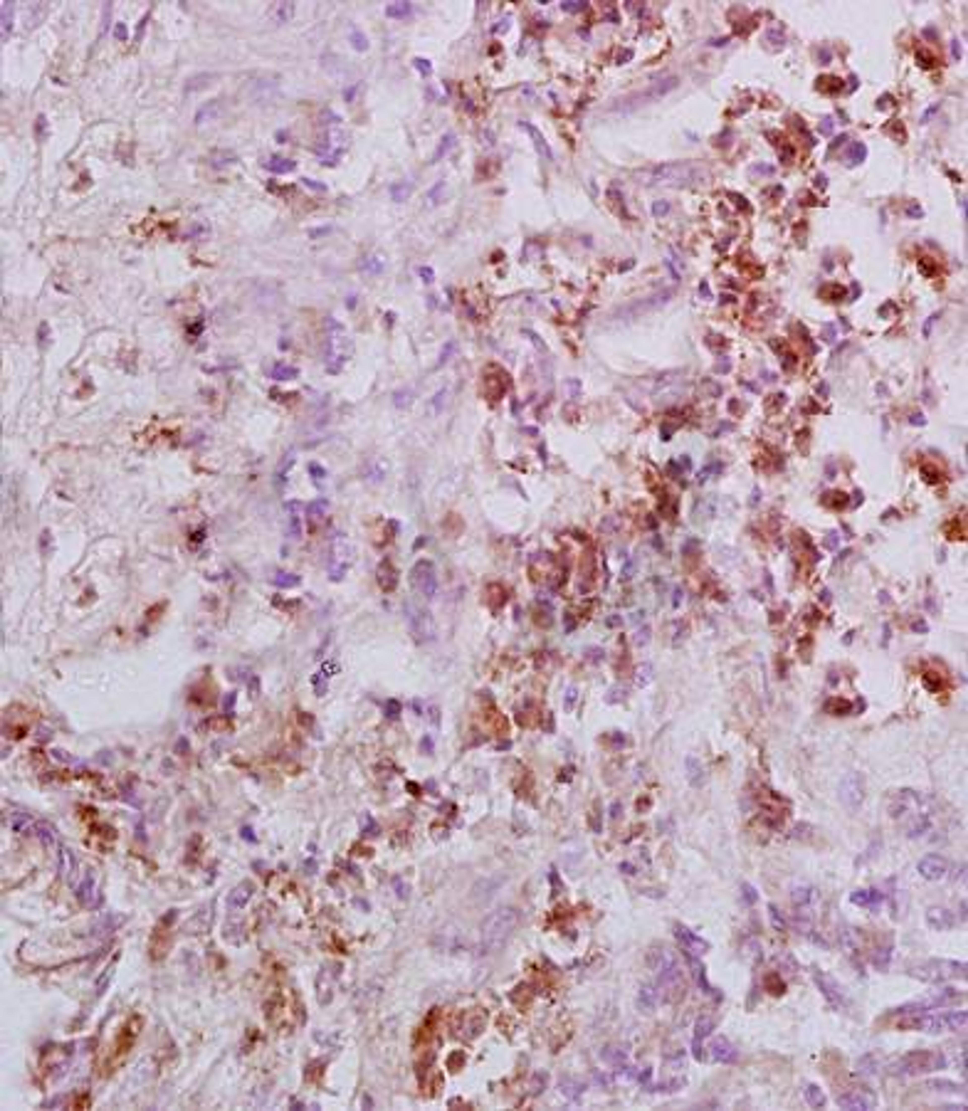 Immunohistochemical analysis of formalin fixed and paraffin embedded human rectal carcinoma using Integrin beta 3 antibody