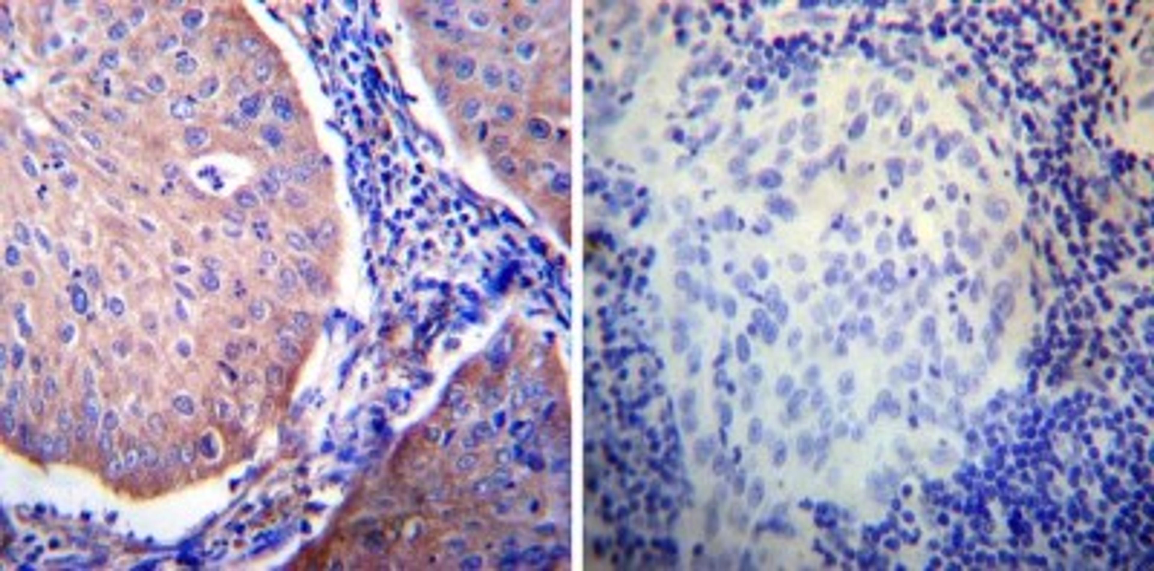 Immunohistochemistry-Paraffin: Glucocorticoid Receptor alpha Antibody [NB300-633] - Both normal and cancer biopsies of deparaffinized Human cervical carcinoma tissues.