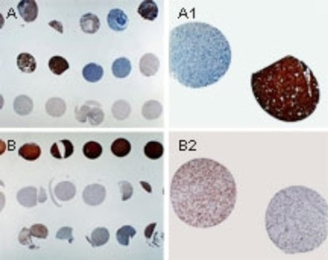 Immunocytochemistry/Immunofluorescence: APAF1 Antibody [NB100-56074] - Formalin-fixed, paraffin-embedded sections from a human brain tumor tissue microarray stained for Apaf 1 expression using NB100-56074 at 1:2000. A and B. Tissue microarray overview. A1 and B1, higher magnification of cores from A and B, respectively. Differential expression of Apaf 1 is seen between patient samples. Hematoxylin-eosin counterstain.