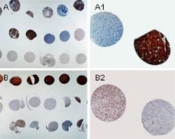 Immunocytochemistry/Immunofluorescence: APAF1 Antibody [NB100-56074] - Formalin-fixed, paraffin-embedded sections from a human brain tumor tissue microarray stained for Apaf 1 expression using NB100-56074 at 1:2000. A and B. Tissue microarray overview. A1 and B1, higher magnification of cores from A and B, respectively. Differential expression of Apaf 1 is seen between patient samples. Hematoxylin-eosin counterstain.