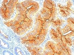 Formalin-fixed, paraffin-embedded human colon carcinoma stained with TAG-72 antibody (SPM148).