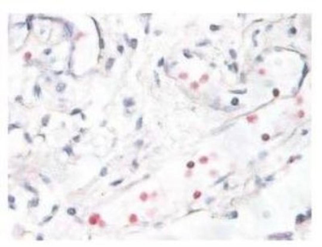 Immunohistochemistry-Paraffin: p38 [p Thr180, p Tyr182] Antibody [NB500-138] - Immunostaining of human breast cancer tissue showing p38 when phosphorylated at Thr180/Tyr182 in red.