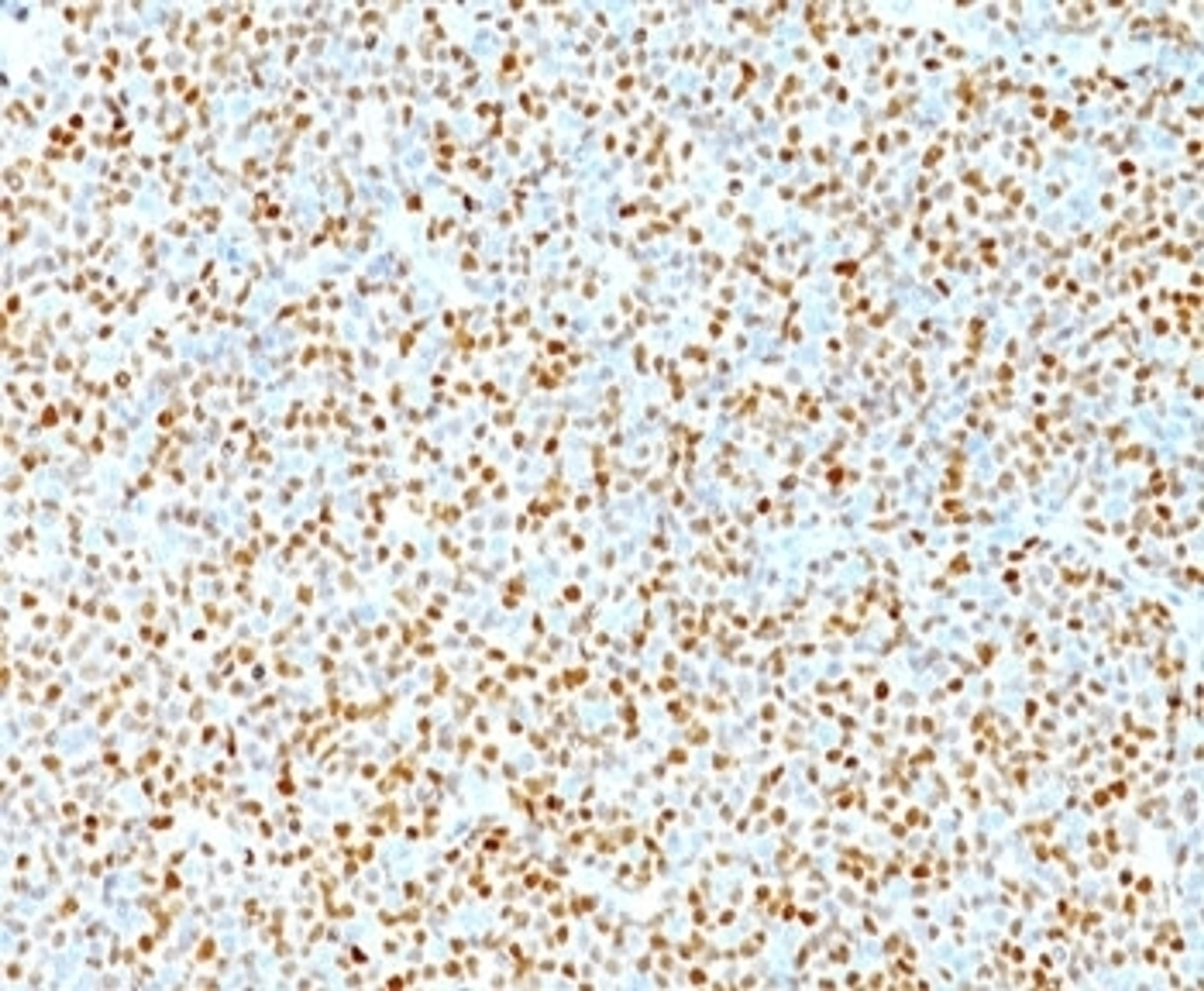 IHC testing of human mantle cell lymphoma stained with Cyclin D1 antibody.  Nuclear staining of tumor cells is seen.