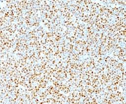 IHC testing of human mantle cell lymphoma stained with Cyclin D1 antibody. Nuclear staining of tumor cells is seen.