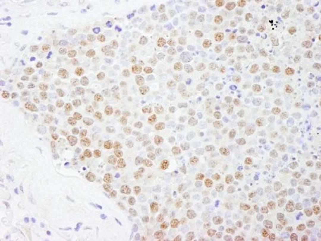 Immunohistochemistry-Paraffin: ILF1 Antibody [NB100-88148] - Human small cell lung cancer. Antibody used at a dilution of 1:200 (1ug/ml).