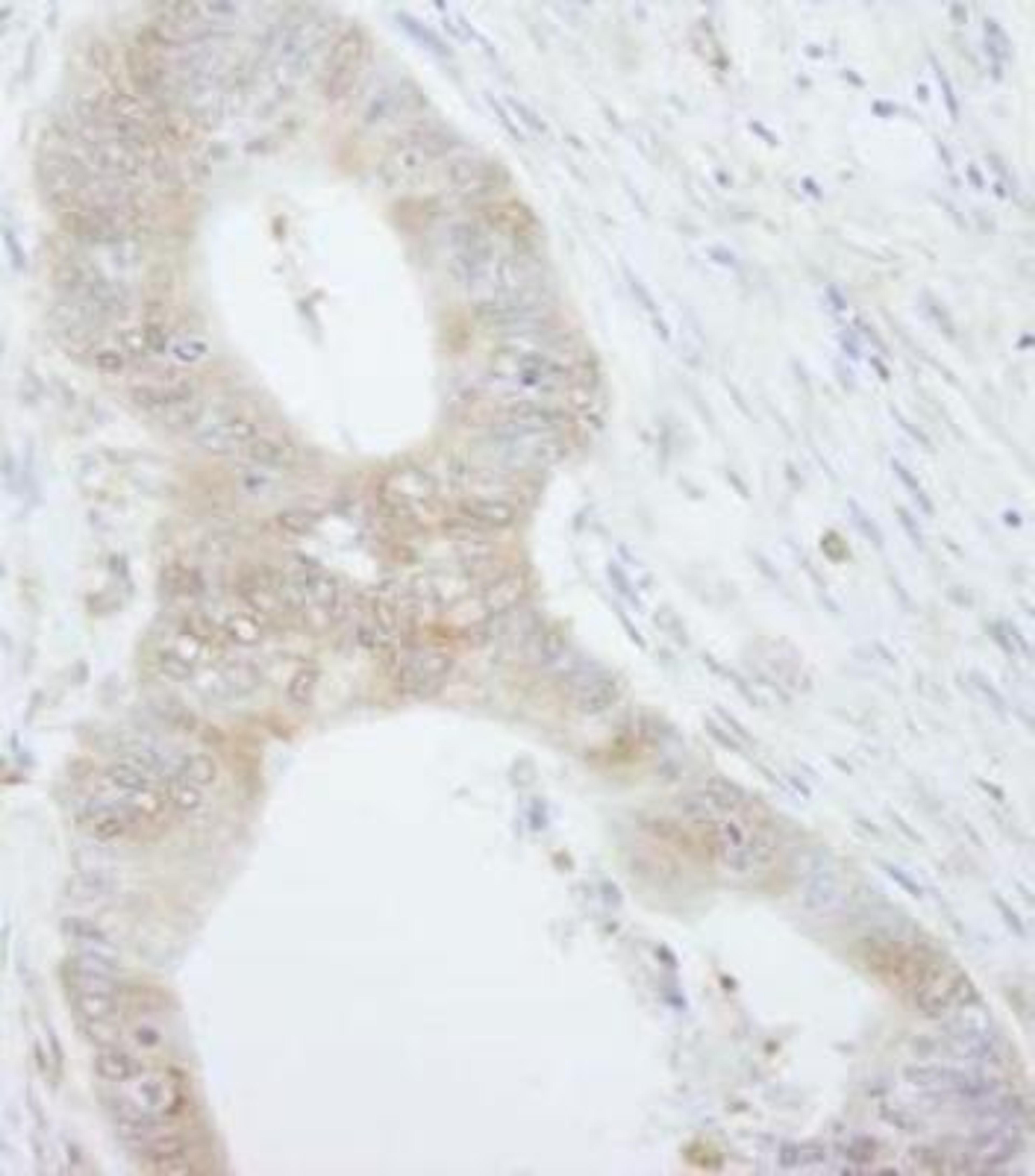 Immunohistochemistry-Paraffin: 4EBP1 Antibody [NB200-157] - Human colon carcinoma.