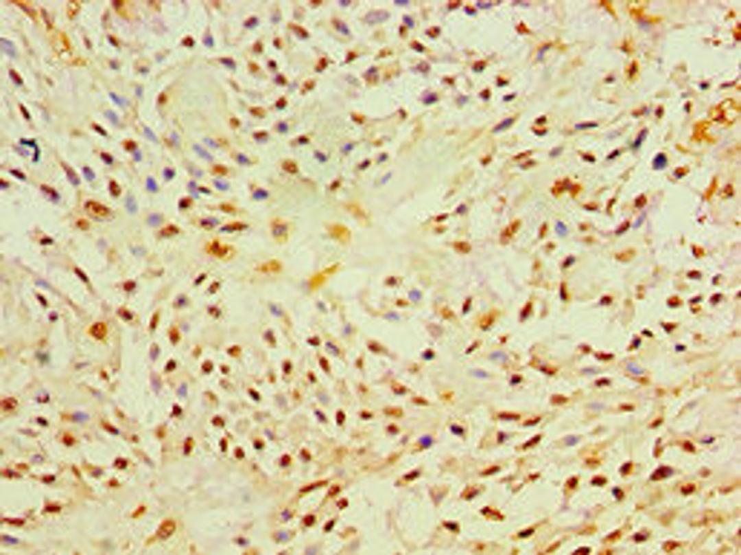 Immunohistochemistry of paraffin-embedded human breast cancer using CSB-PA017340ESR2HU at dilution of 1:100