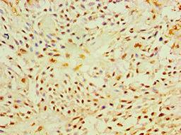 Immunohistochemistry of paraffin-embedded human breast cancer using CSB-PA017340ESR2HU at dilution of 1:100