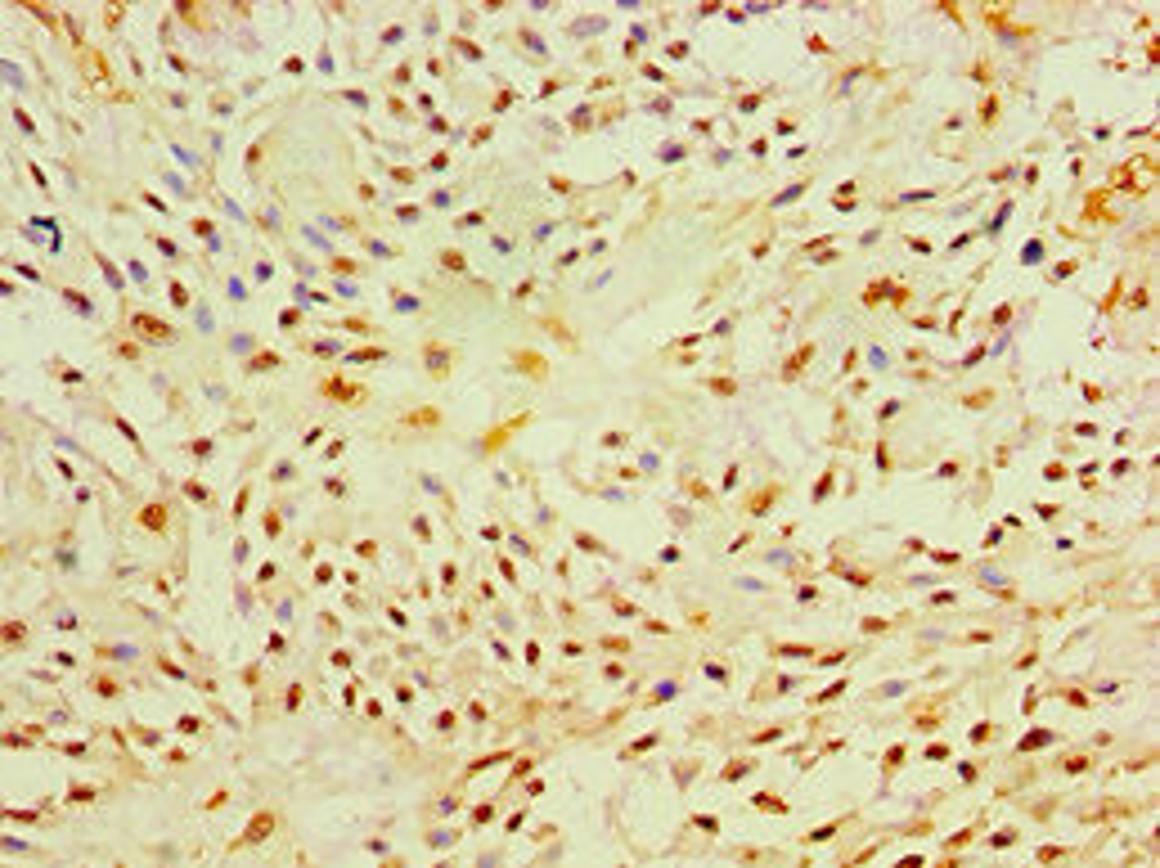 Immunohistochemistry of paraffin-embedded human breast cancer using CSB-PA017340ESR2HU at dilution of 1:100