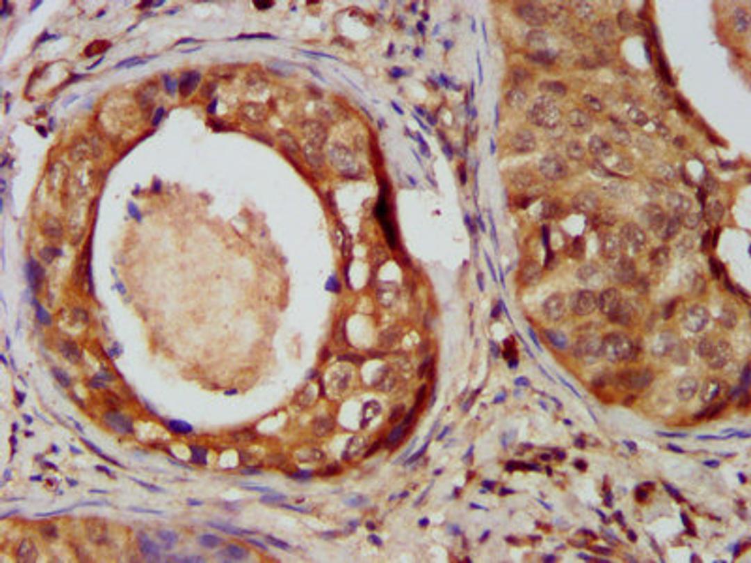 IHC image of CSB-PA800102LA01HU diluted at 1:400 and staining in paraffin-embedded human cervical cancer performed on a Leica BondTM system. After dewaxing and hydration, antigen retrieval was mediated by high pressure in a citrate buffer (pH 6.0). Section was blocked with 10% normal goat serum 30min at RT. Then primary antibody (1% BSA) was incubated at 4°C overnight. The primary is detected by a biotinylated secondary antibody and visualized using an HRP conjugated SP system.