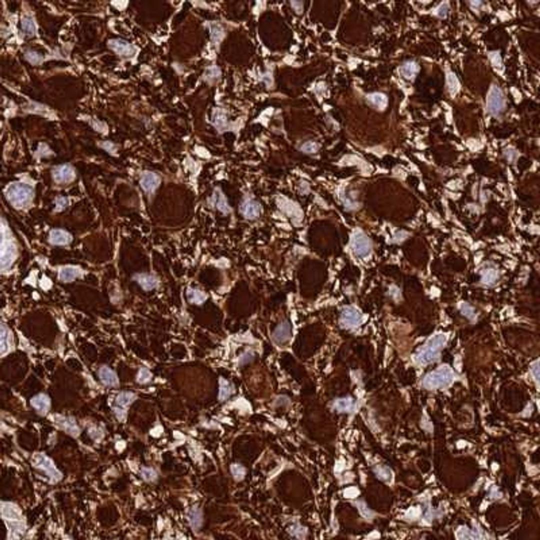 Immunohistochemistry: SHCBP1 Antibody [NBP2-31881] - glioma