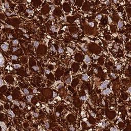 Immunohistochemistry: SHCBP1 Antibody [NBP2-31881] - glioma