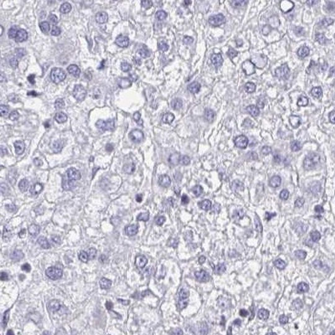 Immunohistochemistry: ARPP19 Antibody [NBP2-31652] - liver cancer