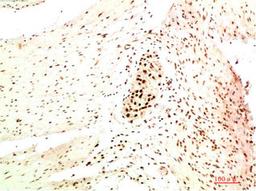 Immunohistochemical analysis of paraffin-embedded Human Colon Carcinoma Tissue using HP-1 α Mouse mAb diluted at 1:200.