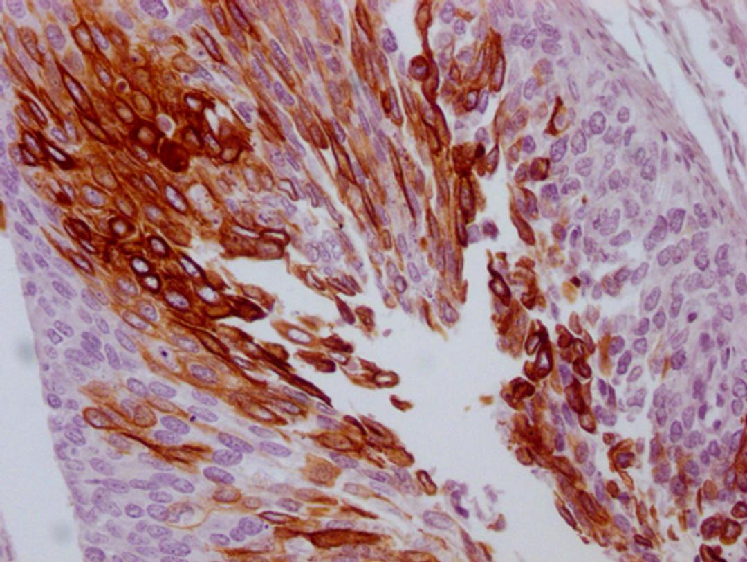 IHC image of CSB-MA299720 diluted at 1:100 and staining in paraffin-embedded human cervical cancer performed on a Leica BondTM system. After dewaxing and hydration, antigen retrieval was mediated by high pressure in a citrate buffer (pH 6.0). Section was blocked with 10% normal goat serum 30min at RT. Then primary antibody (1% BSA) was incubated at 4°C overnight. The primary is detected by a Goat anti-mouse IgG polymer labeled by HRP and visualized using 0.05% DAB.