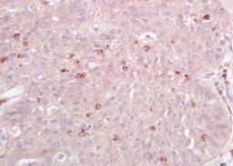 Immunohistochemical analysis of formalin-fixed paraffin embedded human lung carcinoma tissue using IL10 alpha Receptor antibody (dilution at 1:200)