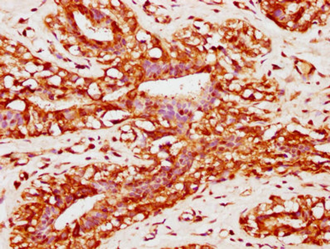 IHC image of CSB-PA890765EA01HU diluted at 1:400 and staining in paraffin-embedded human breast cancer performed on a Leica BondTM system. After dewaxing and hydration, antigen retrieval was mediated by high pressure in a citrate buffer (pH 6.0). Section was blocked with 10% normal goat serum 30min at RT. Then primary antibody (1% BSA) was incubated at 4°C overnight. The primary is detected by a biotinylated secondary antibody and visualized using an HRP conjugated SP system.