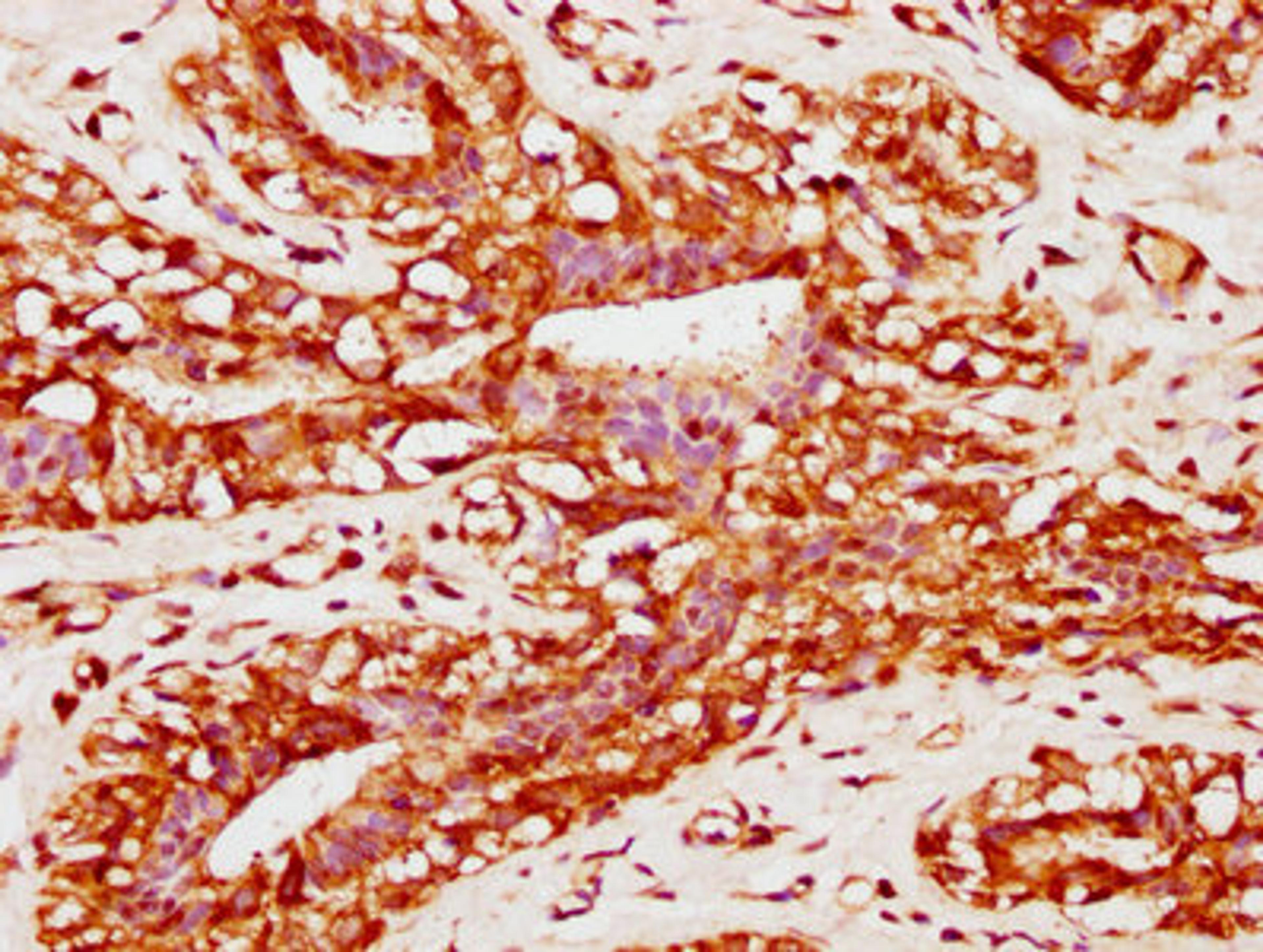 IHC image of CSB-PA890765EA01HU diluted at 1:400 and staining in paraffin-embedded human breast cancer performed on a Leica BondTM system. After dewaxing and hydration, antigen retrieval was mediated by high pressure in a citrate buffer (pH 6.0). Section was blocked with 10% normal goat serum 30min at RT. Then primary antibody (1% BSA) was incubated at 4°C overnight. The primary is detected by a biotinylated secondary antibody and visualized using an HRP conjugated SP system.