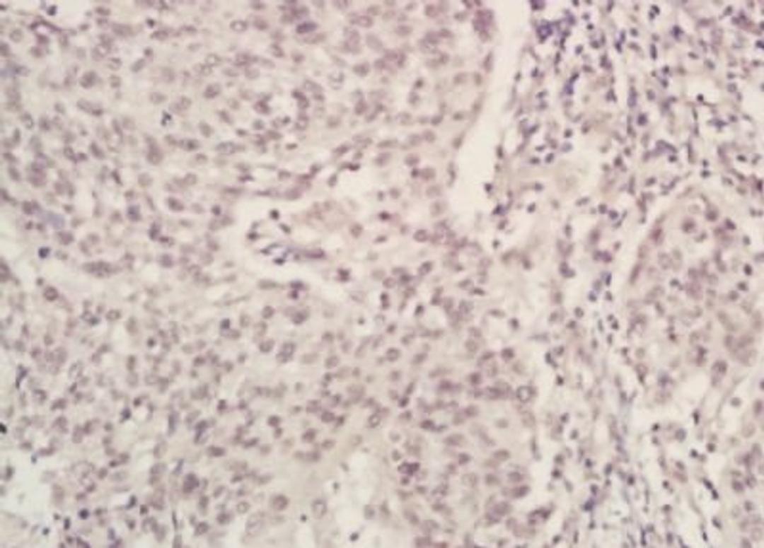 Immunohistochemical analysis of formalin-fixed paraffin embedded human laryngocarcinoma tissue using Brucella antibody (dilution at 1:200)