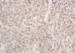 Immunohistochemical analysis of formalin-fixed paraffin embedded human laryngocarcinoma tissue using Brucella antibody (dilution at 1:200)