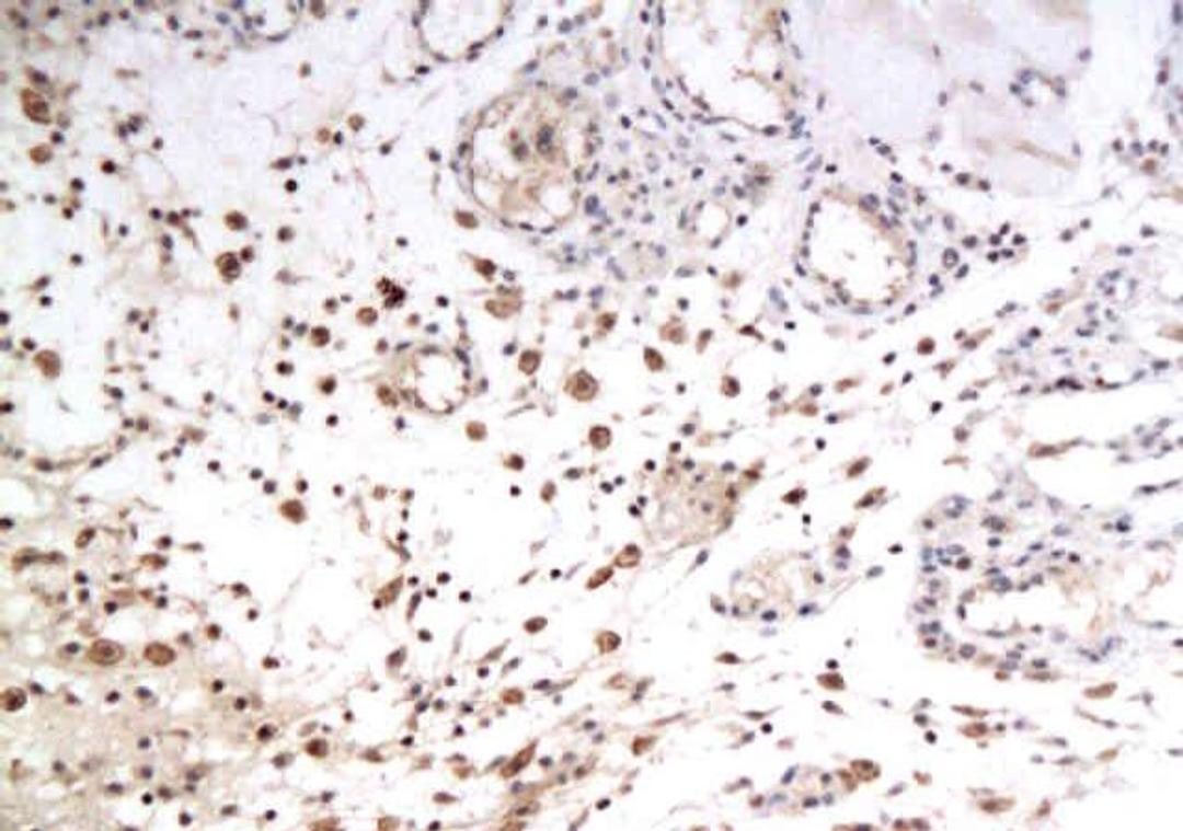 IHC-P of rat subcutaneous tumor transplantation using GLUT12 antibody.