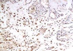 IHC-P of rat subcutaneous tumor transplantation using GLUT12 antibody.