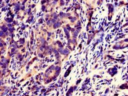Immunohistochemistry of paraffin-embedded human pancreatic cancer using CSB-PA867117LA01HU at dilution of 1:100