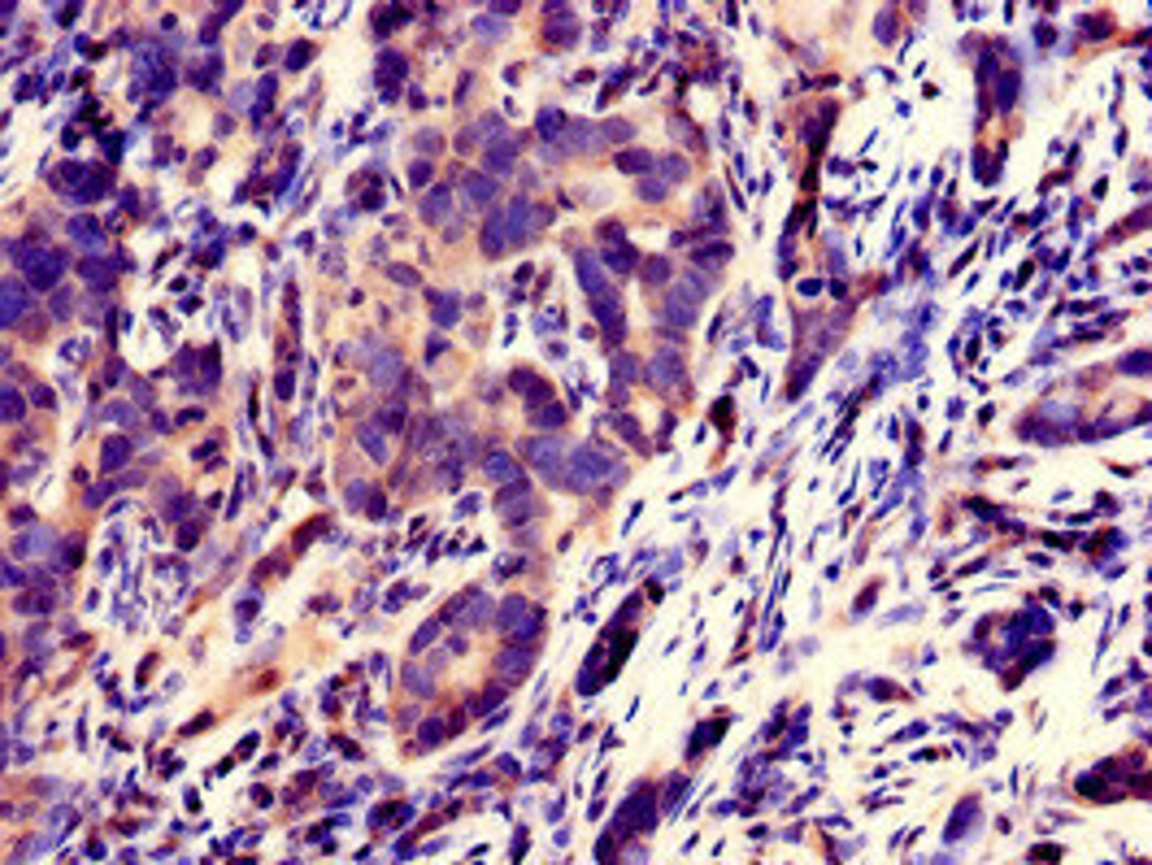 Immunohistochemistry of paraffin-embedded human pancreatic cancer using CSB-PA867117LA01HU at dilution of 1:100