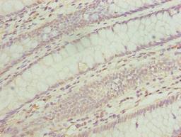 Immunohistochemistry of paraffin-embedded human colon cancer using CSB-PA874810LA01HU at dilution of 1:100