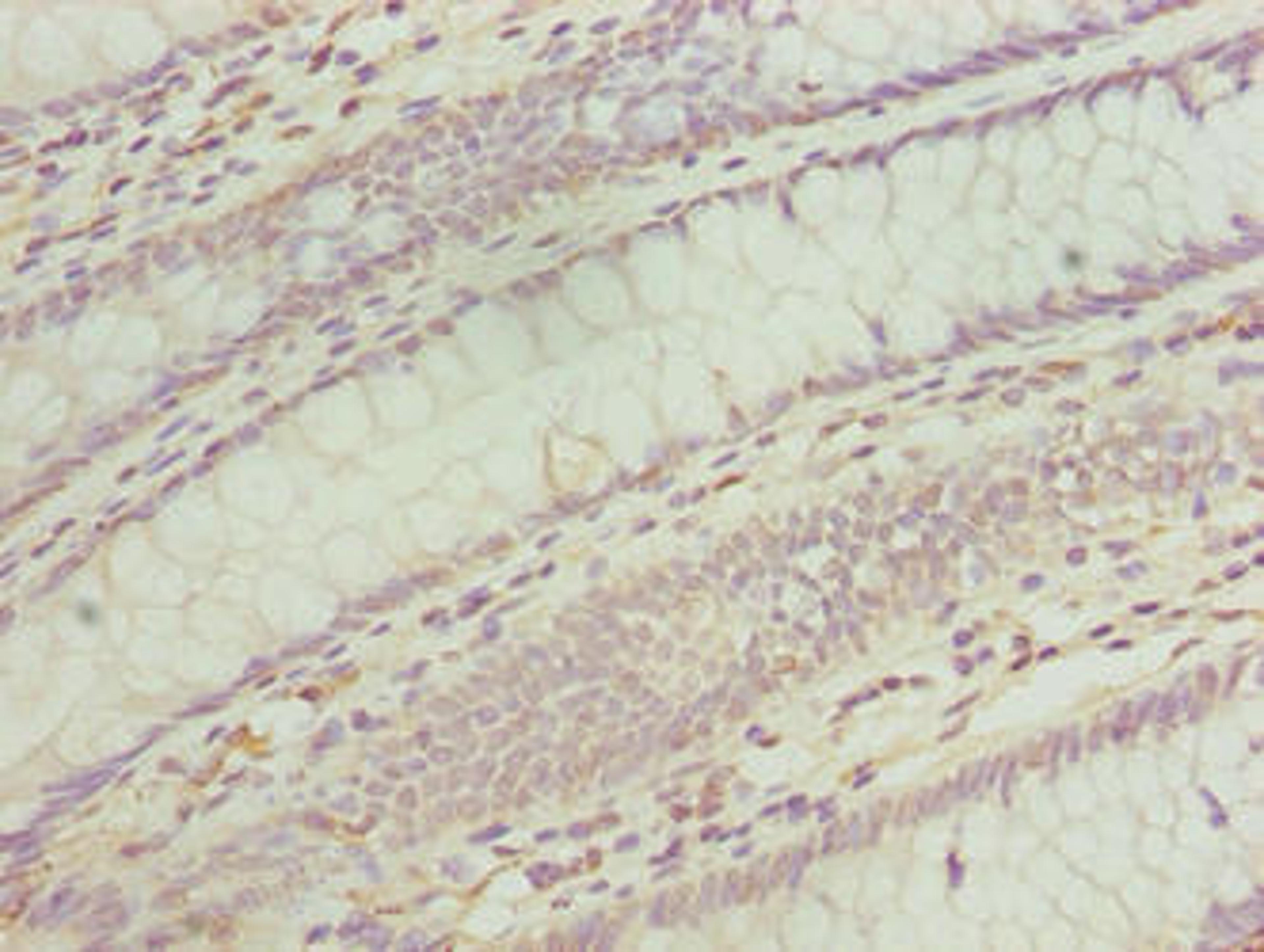 Immunohistochemistry of paraffin-embedded human colon cancer using CSB-PA874810LA01HU at dilution of 1:100