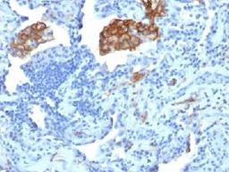 Immunohistochemical staining of human Lung Carcinoma tissue using CD209 antibody