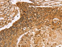 The image on the left is immunohistochemistry of paraffin-embedded Human esophagus cancer tissue using CSB-PA200577(VIM Antibody) at dilution 1/20, on the right is treated with fusion protein. (Original magnification: ×200)