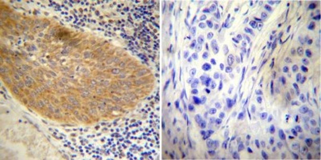 Immunohistochemistry-Paraffin: GR/NR3C1 Antibody [NB300-610] - Both normal and cancer biopsies of deparaffinized human Cervical carcinoma tissue.