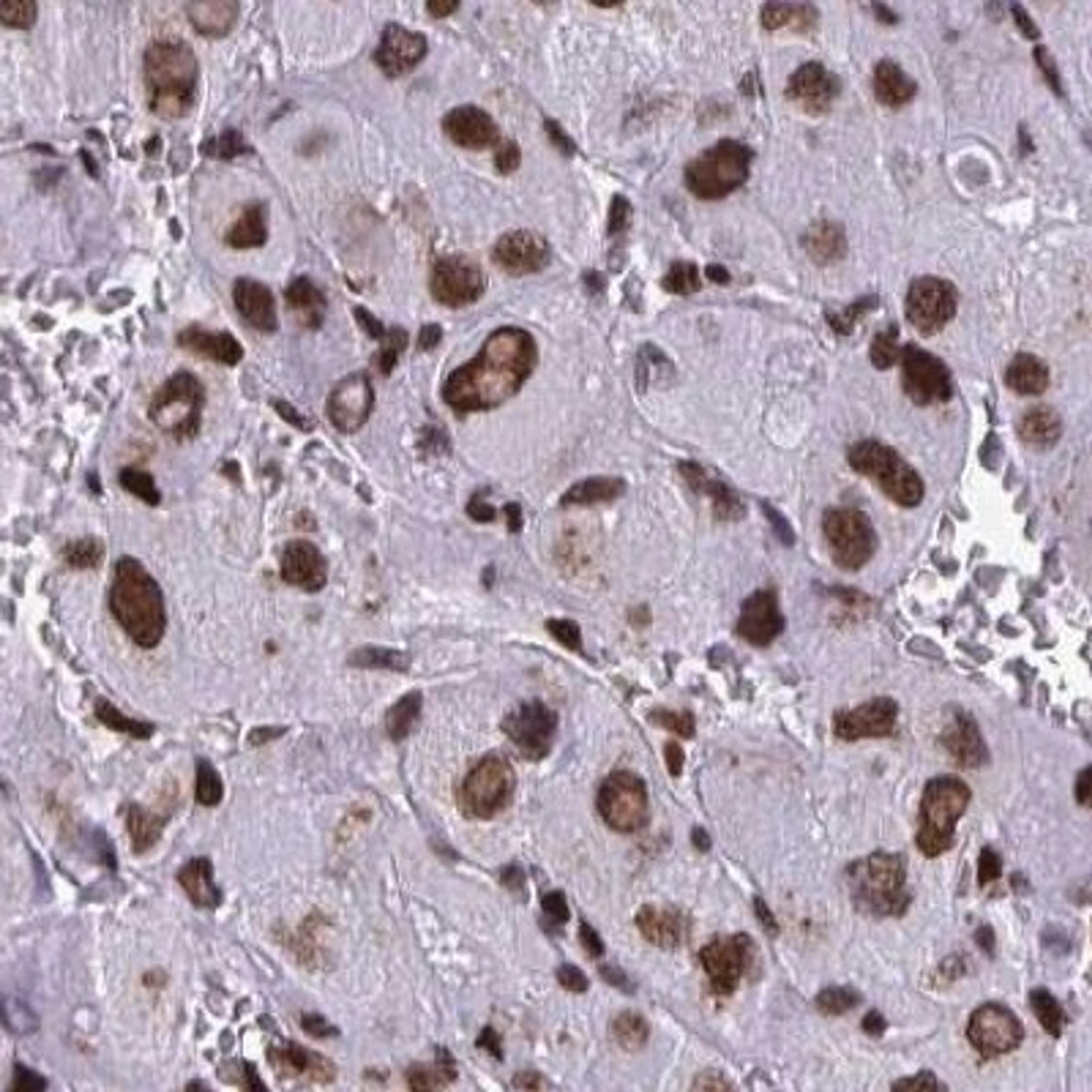 Immunohistochemistry: SLC35C2 Antibody [NBP2-32008] - liver cancer