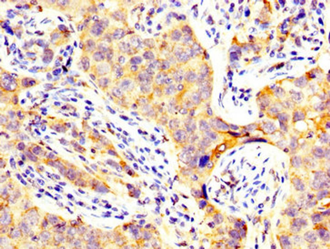 IHC image of CSB-PA13269A0Rb diluted at 1:300 and staining in paraffin-embedded human pancreatic cancer performed on a Leica BondTM system. After dewaxing and hydration, antigen retrieval was mediated by high pressure in a citrate buffer (pH 6.0). Section was blocked with 10% normal goat serum 30min at RT. Then primary antibody (1% BSA) was incubated at 4&deg;C overnight. The primary is detected by a biotinylated secondary antibody and visualized using an HRP conjugated SP system.