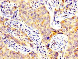 IHC image of CSB-PA13269A0Rb diluted at 1:300 and staining in paraffin-embedded human pancreatic cancer performed on a Leica BondTM system. After dewaxing and hydration, antigen retrieval was mediated by high pressure in a citrate buffer (pH 6.0). Section was blocked with 10% normal goat serum 30min at RT. Then primary antibody (1% BSA) was incubated at 4&deg;C overnight. The primary is detected by a biotinylated secondary antibody and visualized using an HRP conjugated SP system.
