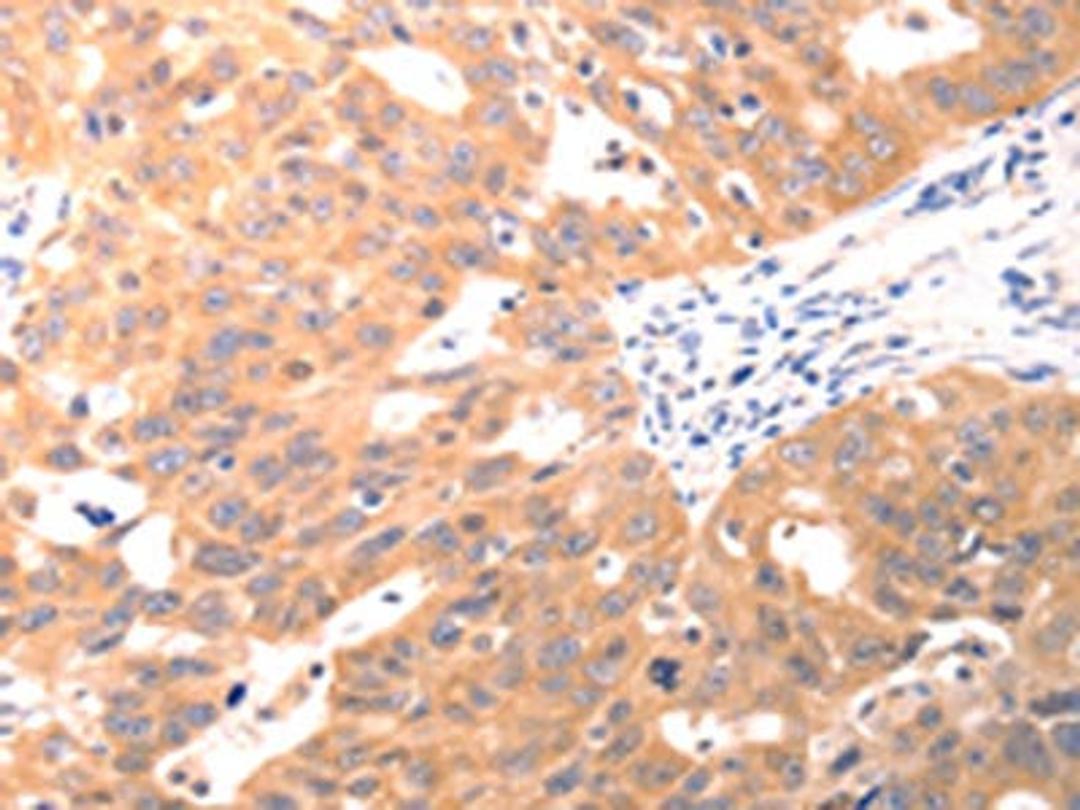 The image on the left is immunohistochemistry of paraffin-embedded Human ovarian cancer tissue using CSB-PA796509(CAPNS1 Antibody) at dilution 1/60, on the right is treated with fusion protein. (Original magnification: ×200)
