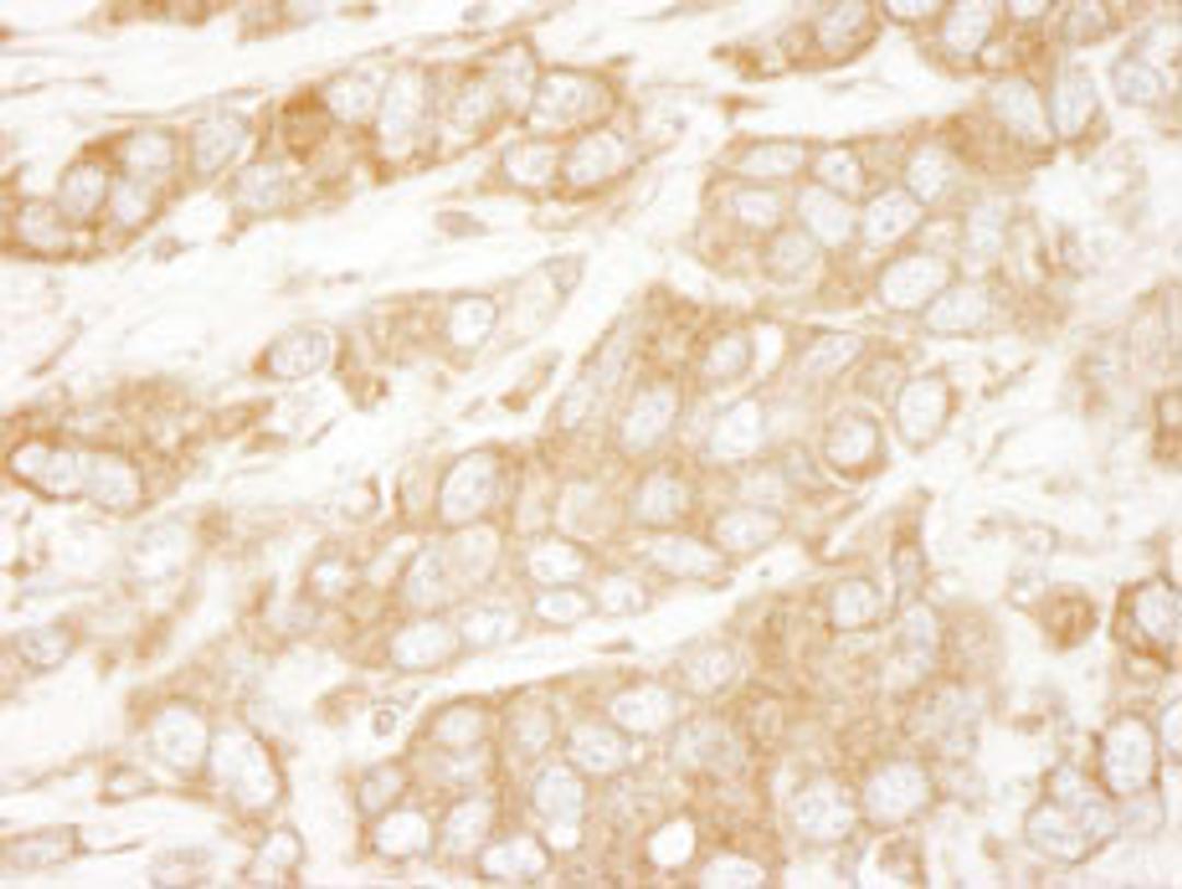 Detection of human PTEN by immunohistochemistry.