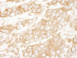 Detection of human PTEN by immunohistochemistry.