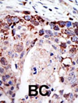 Formalin-fixed and paraffin-embedded human cancer tissue reacted with the primary antibody, which was peroxidase-conjugated to the secondary antibody, followed by AEC staining. BC = breast carcinoma; HC = hepatocarcinoma.