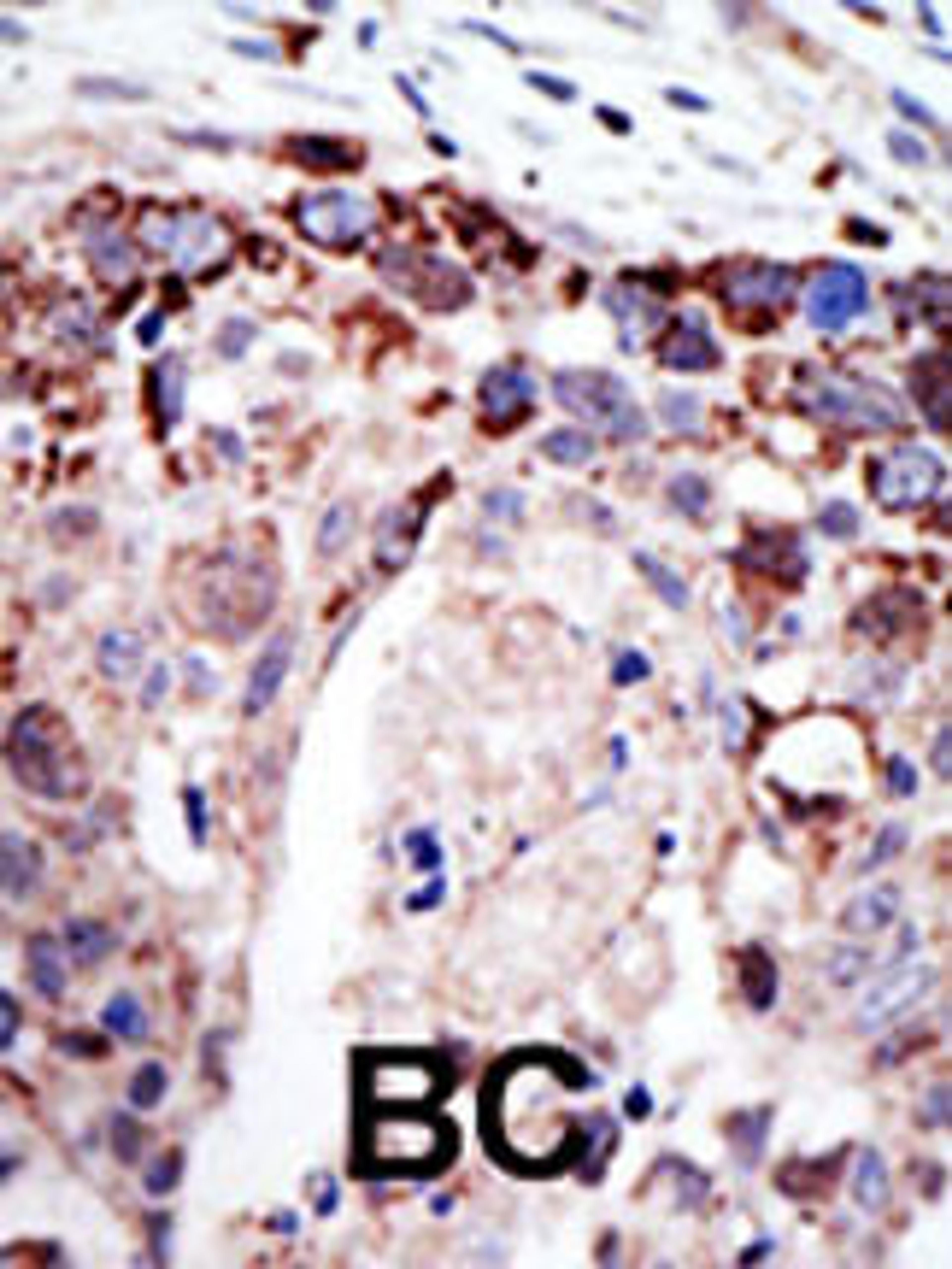 Formalin-fixed and paraffin-embedded human cancer tissue reacted with the primary antibody, which was peroxidase-conjugated to the secondary antibody, followed by AEC staining. BC = breast carcinoma; HC = hepatocarcinoma.