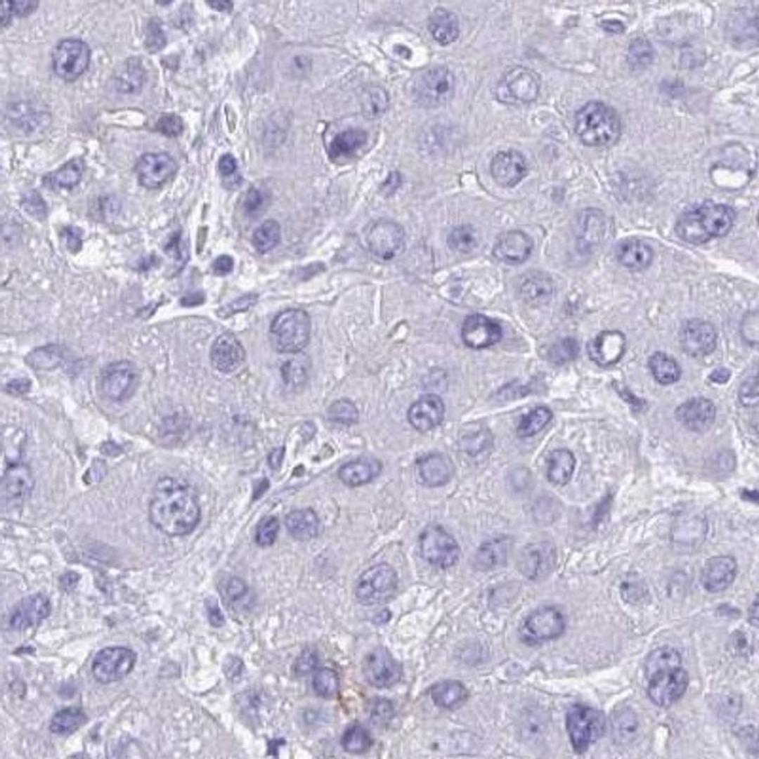 Immunohistochemistry: DCAKD Antibody [NBP2-31843] - liver cancer