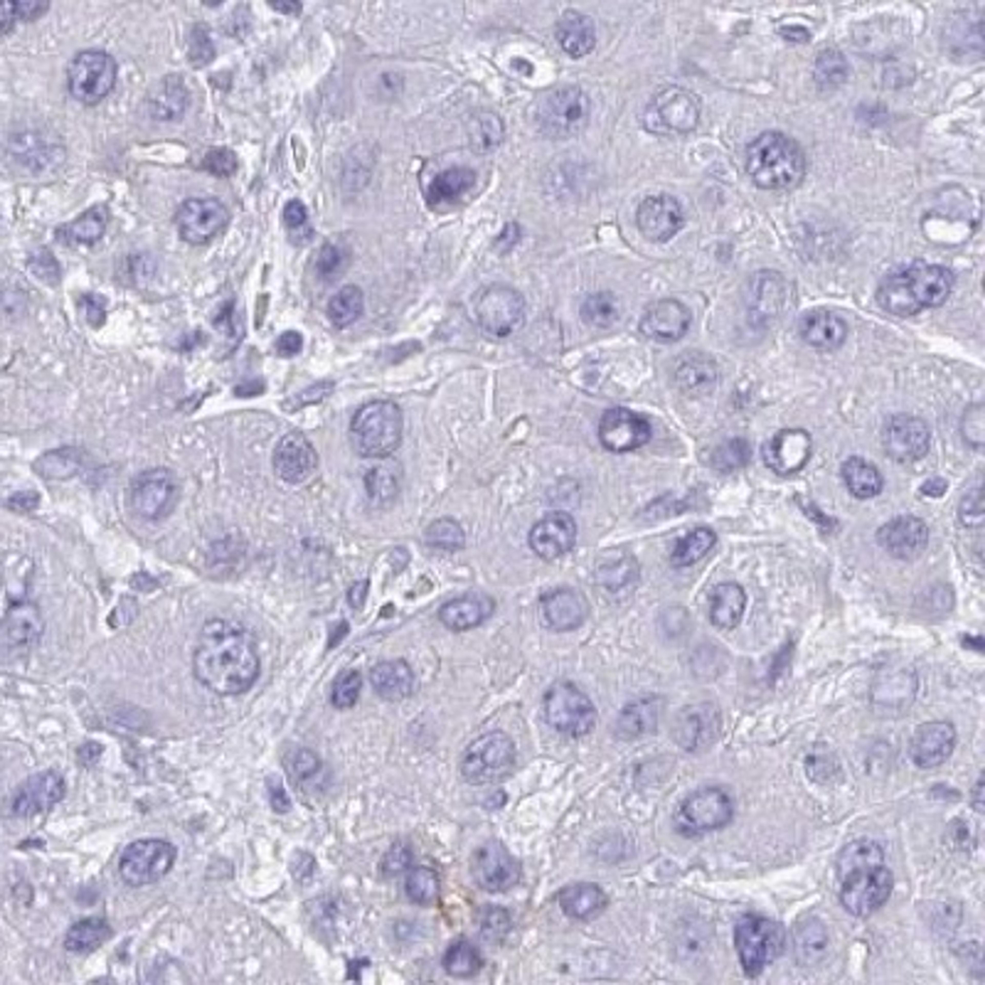 Immunohistochemistry: DCAKD Antibody [NBP2-31843] - liver cancer