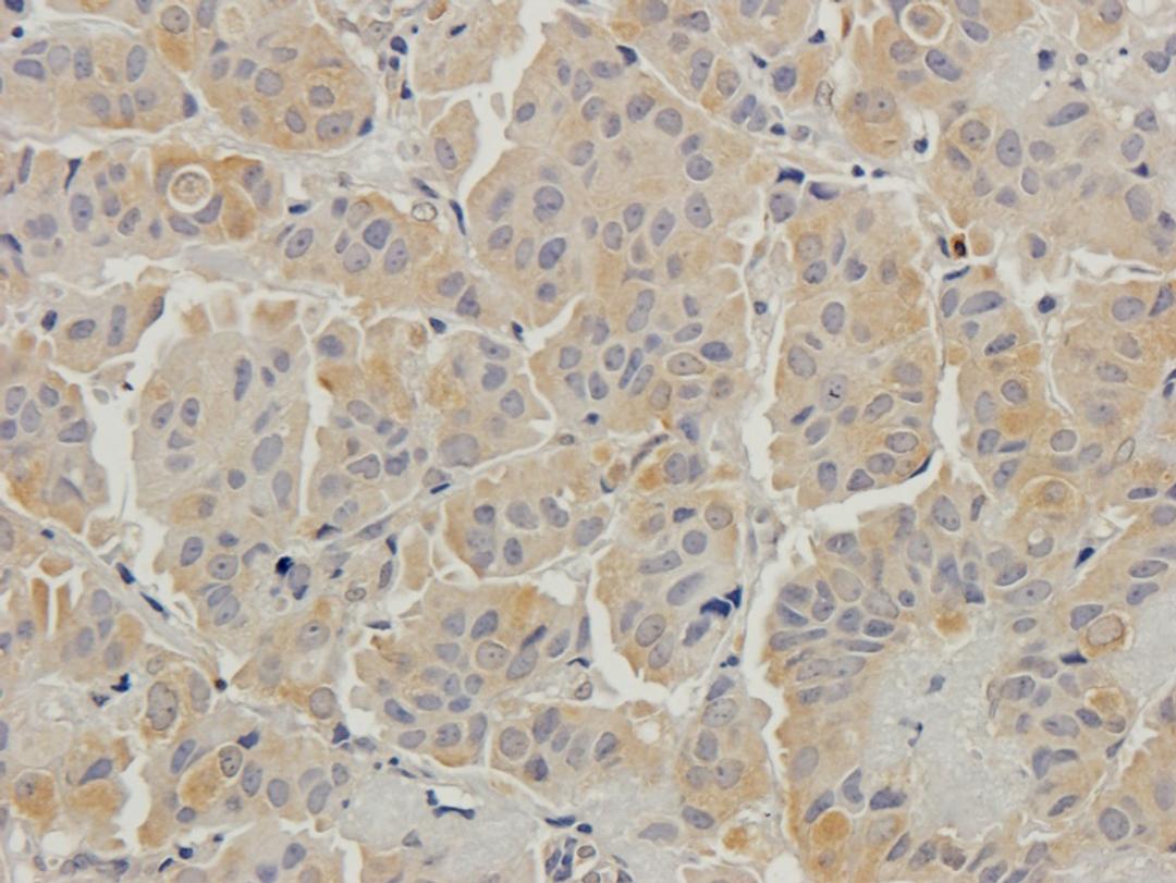 Immunohistochemical staining of human breast cancer tissue using Beclin 1 antibody (2.5 ug/ml)