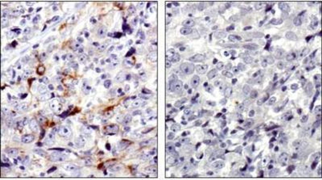 Immunohistochemistry: MMP-7 Antibody [NBP1-99123] -  MMP7 antibody was tested in human breast cancer using DAB with hematoxylin counterstain. The image on the right had the antibody blocked by preincubation with immunizing peptide.