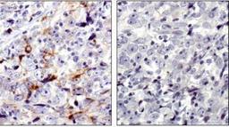 Immunohistochemistry: MMP-7 Antibody [NBP1-99123] -  MMP7 antibody was tested in human breast cancer using DAB with hematoxylin counterstain. The image on the right had the antibody blocked by preincubation with immunizing peptide.