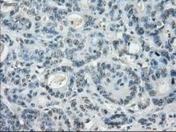 Immunohistochemistry-Paraffin: Leukotriene A4 hydrolase Antibody (1E9) [NBP1-47829] - Staining of paraffin-embedded Adenocarcinoma of colon tissue using anti-Leukotriene A4 hydrolase mouse monoclonal antibody.