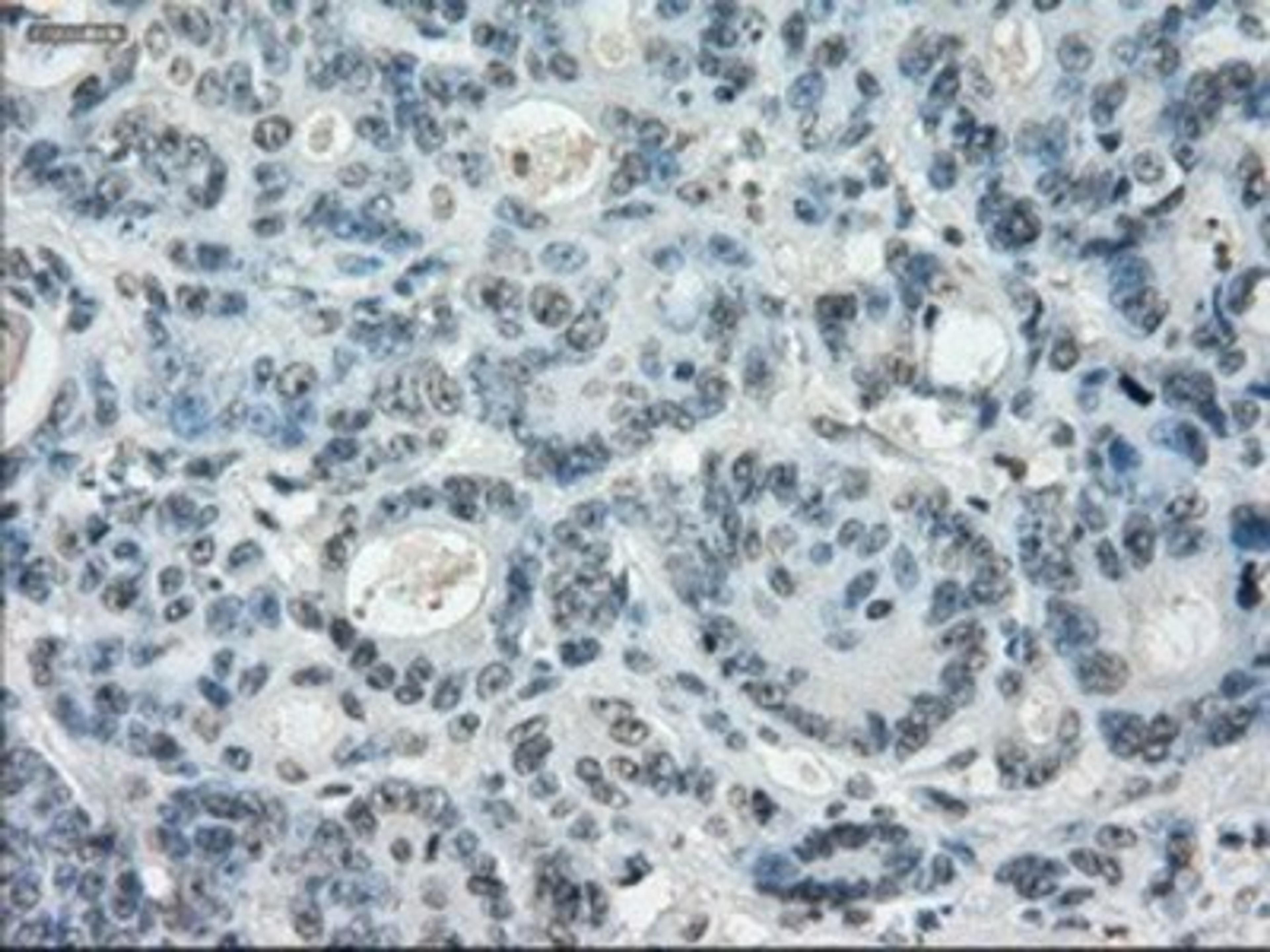 Immunohistochemistry-Paraffin: Leukotriene A4 hydrolase Antibody (1E9) [NBP1-47829] - Staining of paraffin-embedded Adenocarcinoma of colon tissue using anti-Leukotriene A4 hydrolase mouse monoclonal antibody.