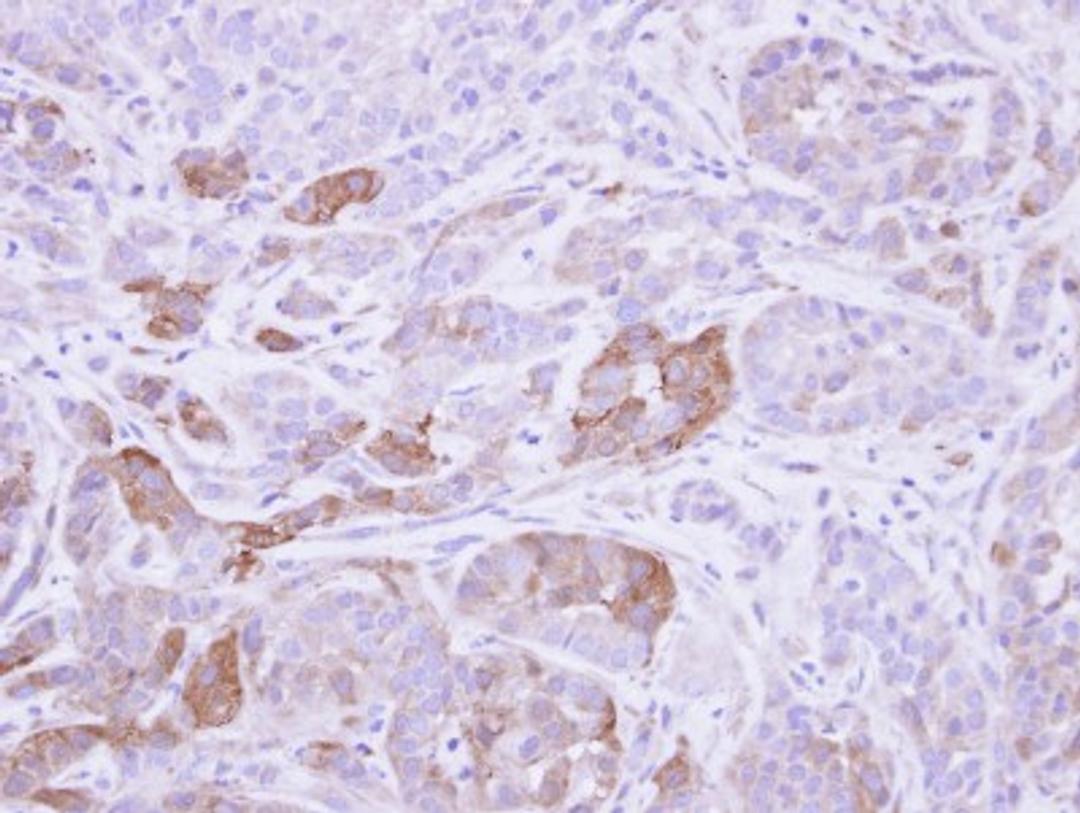 Immunohistochemistry-Paraffin: Villin 1 Antibody [NBP1-32841] - Paraffin-embedded A549 xenograft, using antibody at 1:500 dilution.