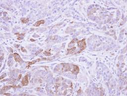 Immunohistochemistry-Paraffin: Villin 1 Antibody [NBP1-32841] - Paraffin-embedded A549 xenograft, using antibody at 1:500 dilution.